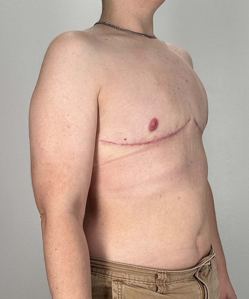 Ftm Top Surgery Before & After