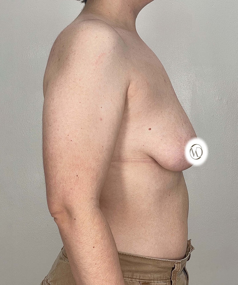 Ftm Top Surgery Before & After