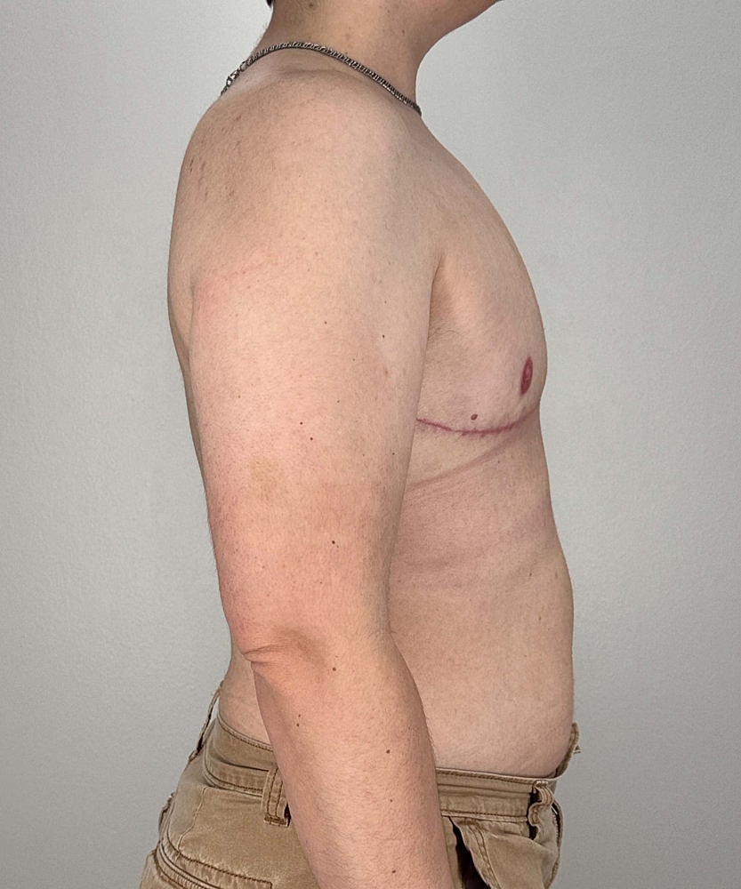 Ftm Top Surgery Before & After