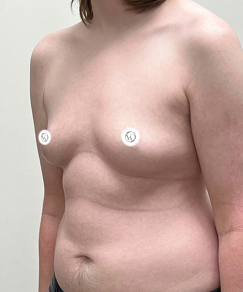 Ftm Top Surgery Before & After