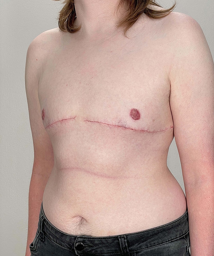 Ftm Top Surgery Before & After