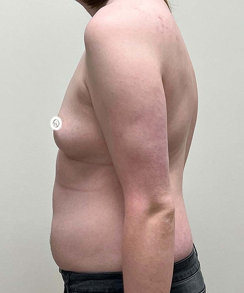 Ftm Top Surgery Before & After