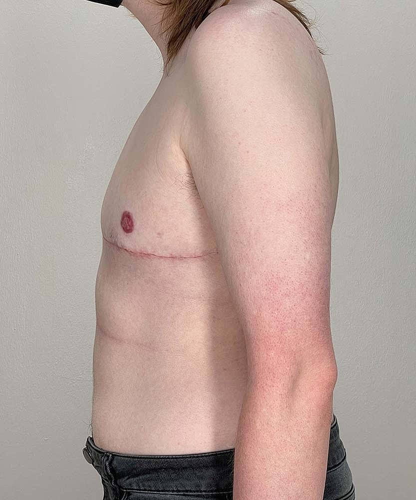Ftm Top Surgery Before & After