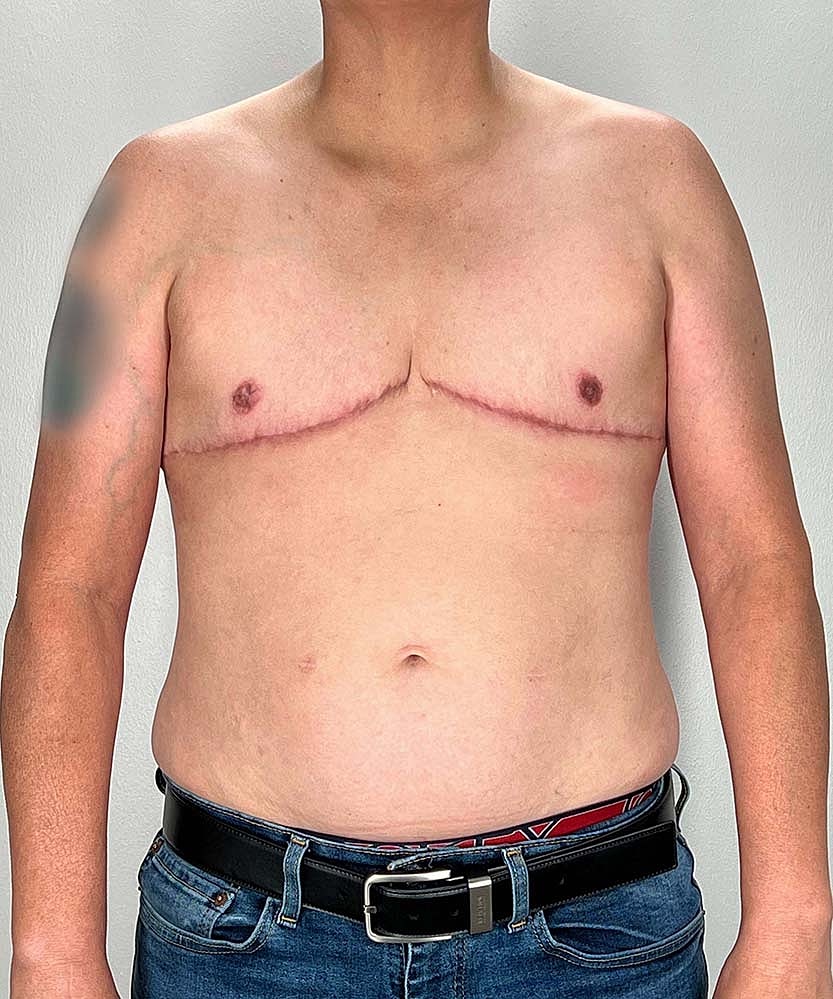 Ftm Top Surgery Before & After