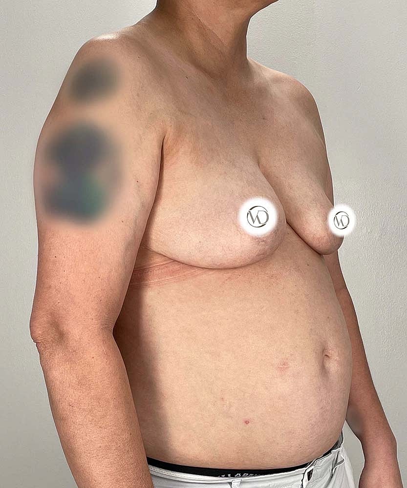Ftm Top Surgery Before & After