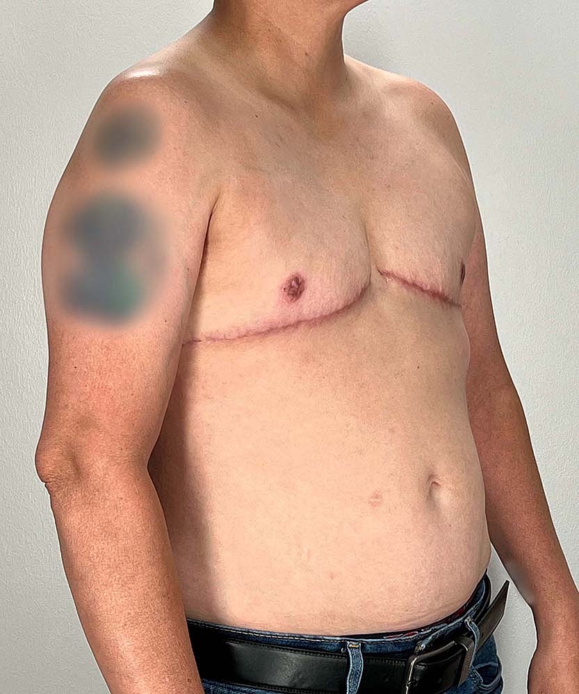 Ftm Top Surgery Before & After