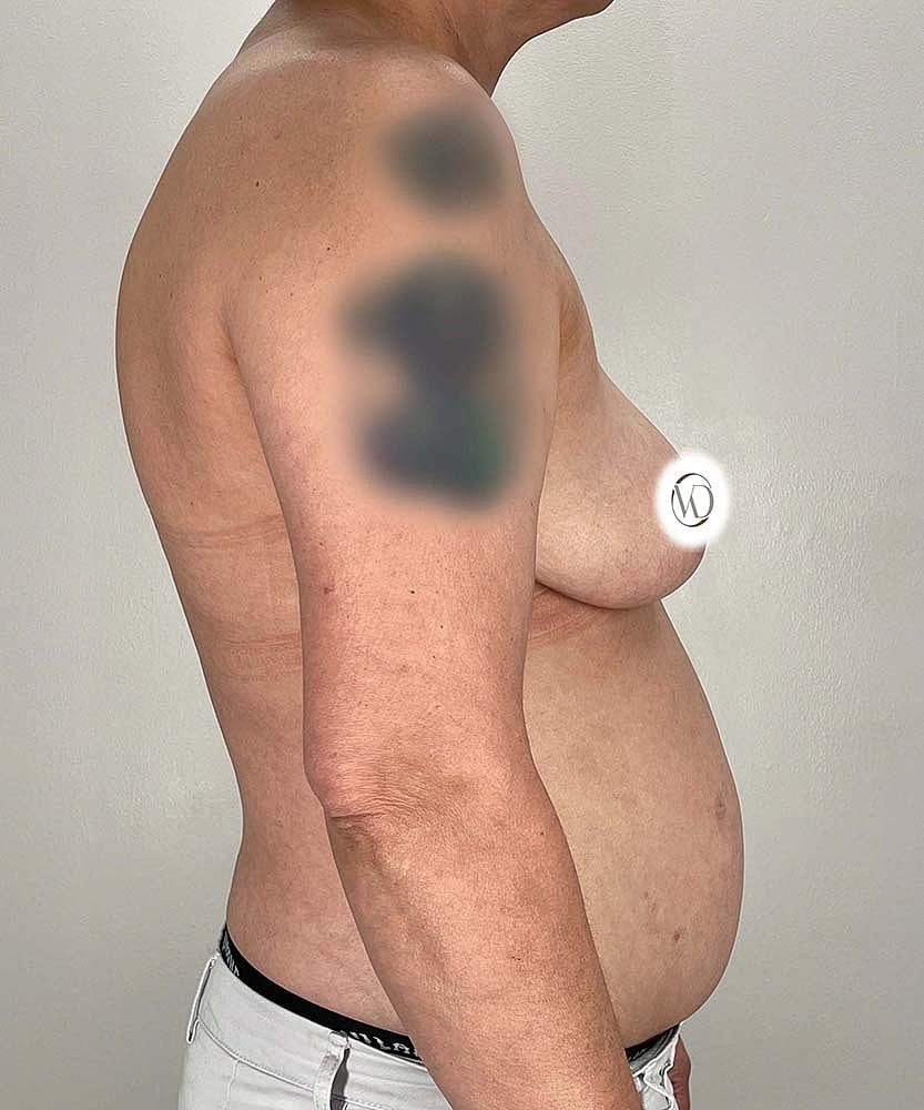 Ftm Top Surgery Before & After