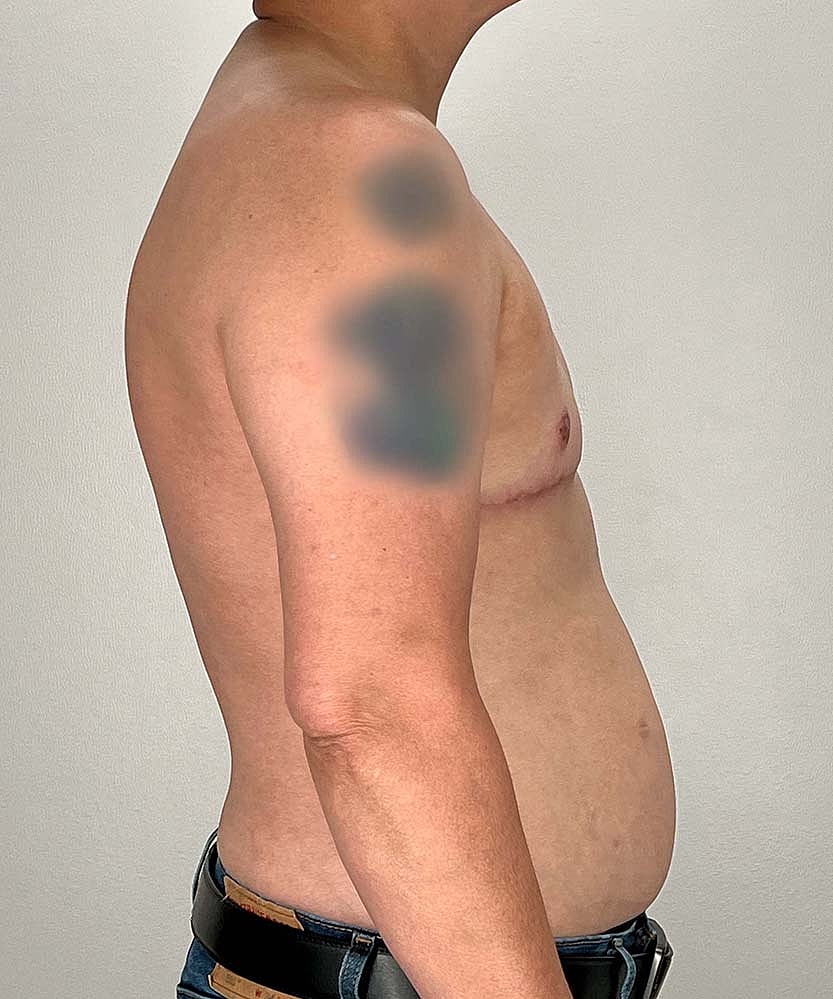 Ftm Top Surgery Before & After