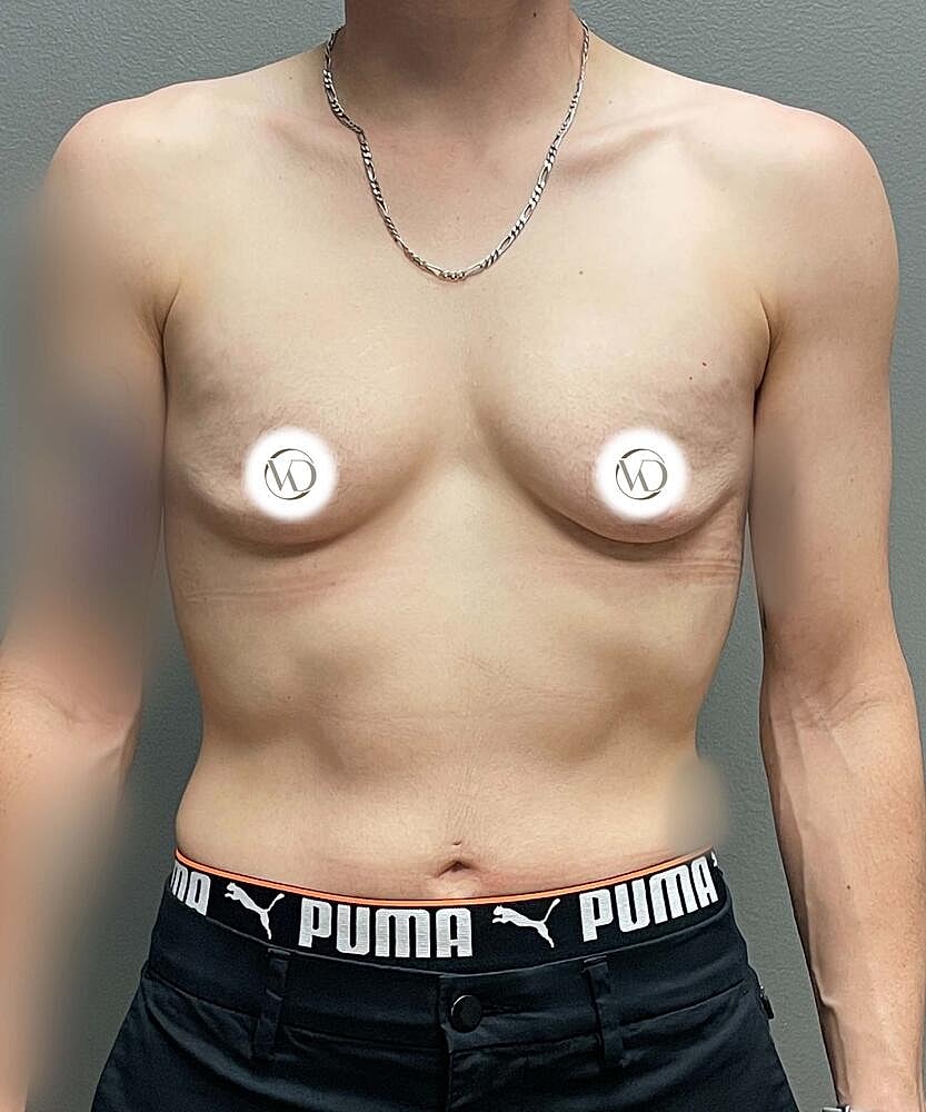 Ftm Top Surgery Before & After
