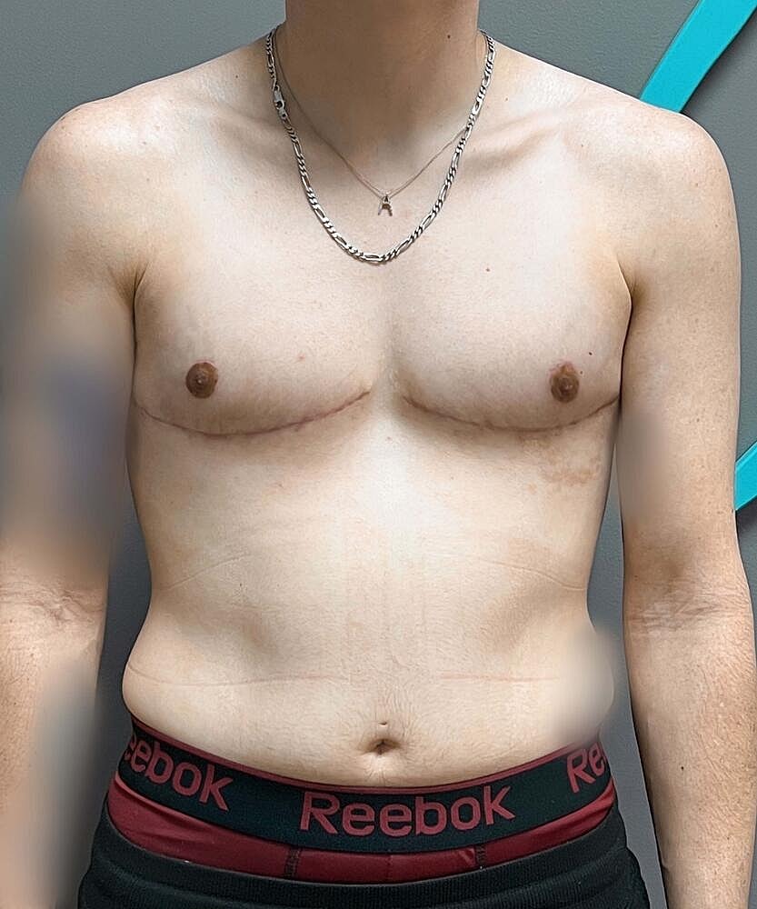 Ftm Top Surgery Before & After