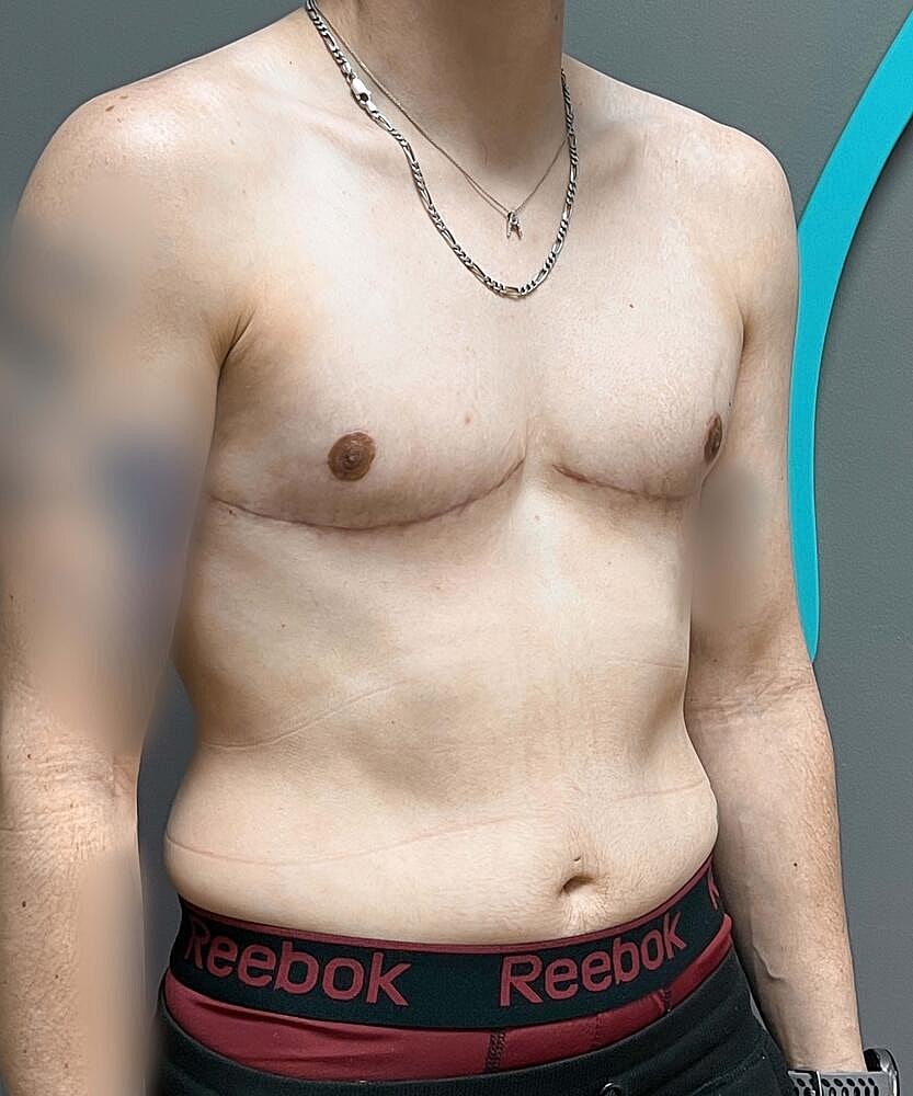 Ftm Top Surgery Before & After