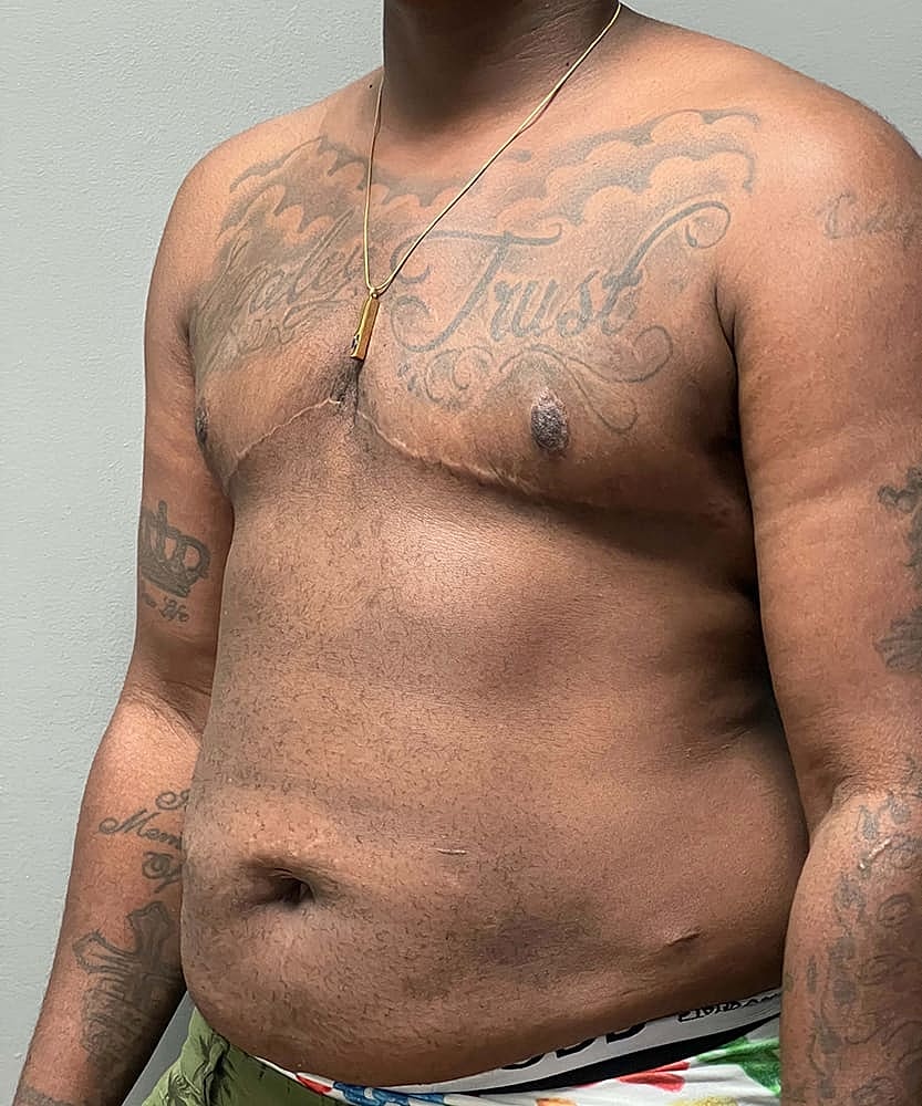 Ftm Top Surgery Before & After