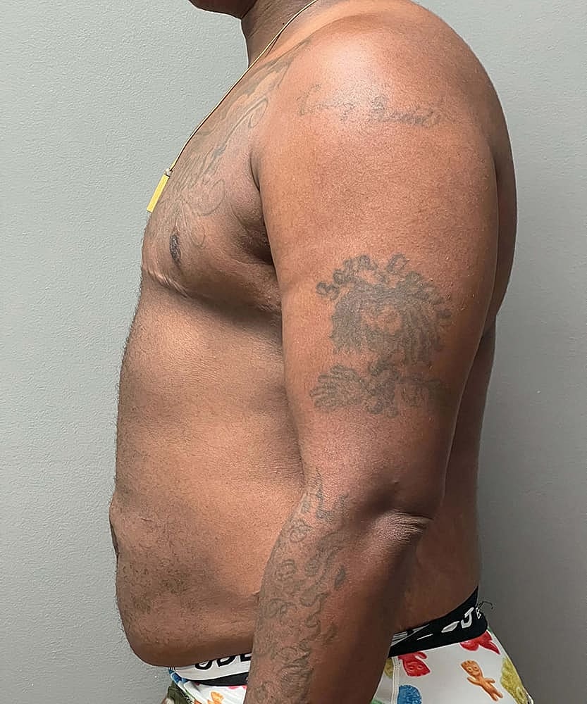 Ftm Top Surgery Before & After