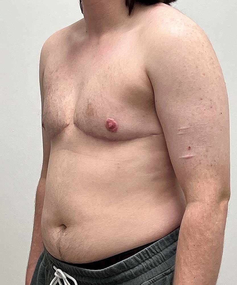 Ftm Top Surgery Before & After