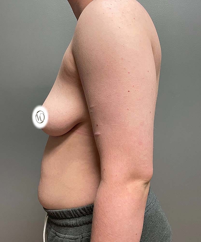 Ftm Top Surgery Before & After
