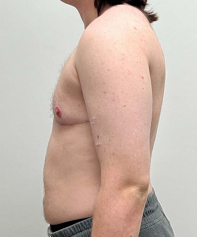 Ftm Top Surgery Before & After