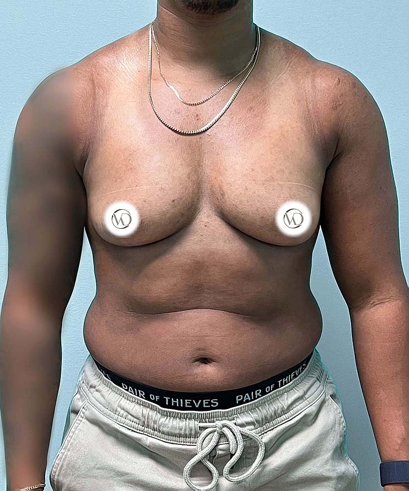 Ftm Top Surgery Before & After