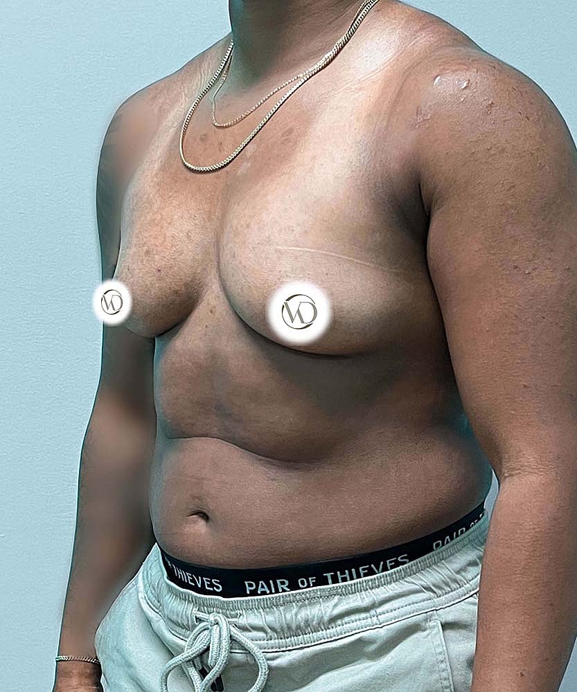 Ftm Top Surgery Before & After