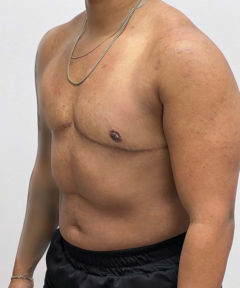 Ftm Top Surgery Before & After