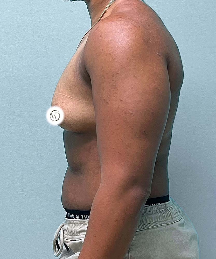 Ftm Top Surgery Before & After