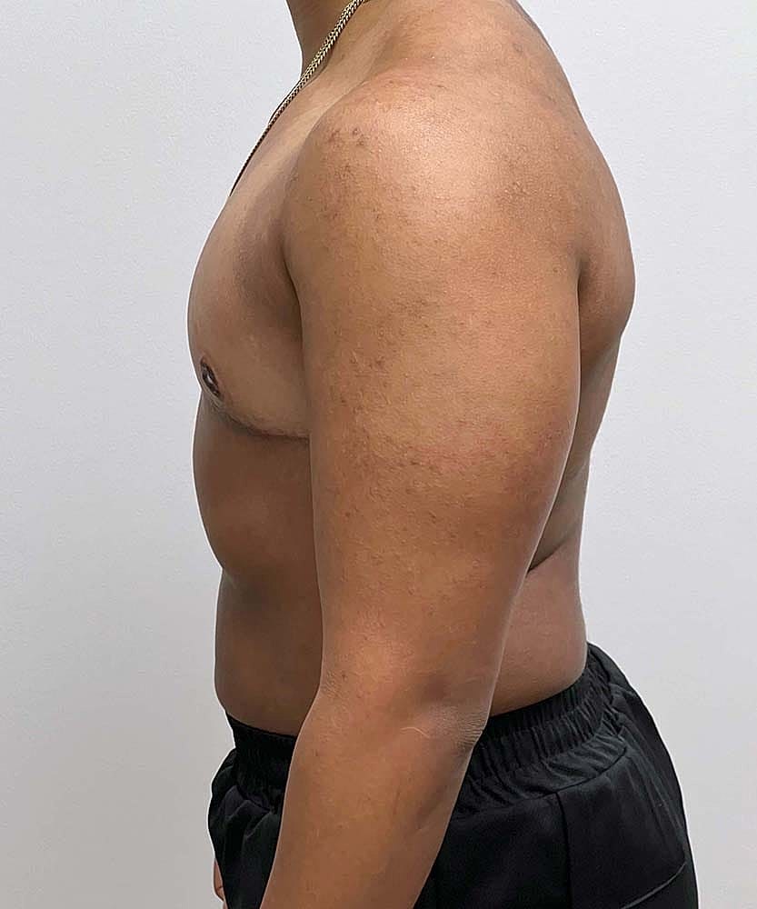 Ftm Top Surgery Before & After