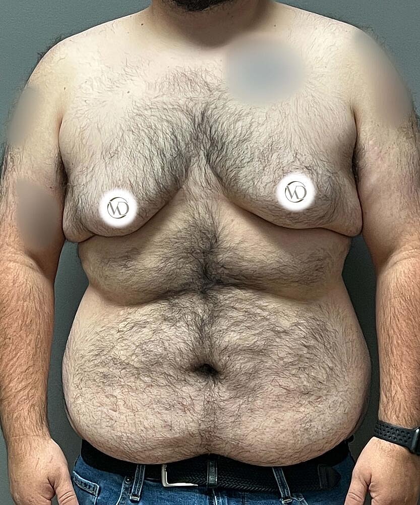 Ftm Top Surgery Before & After
