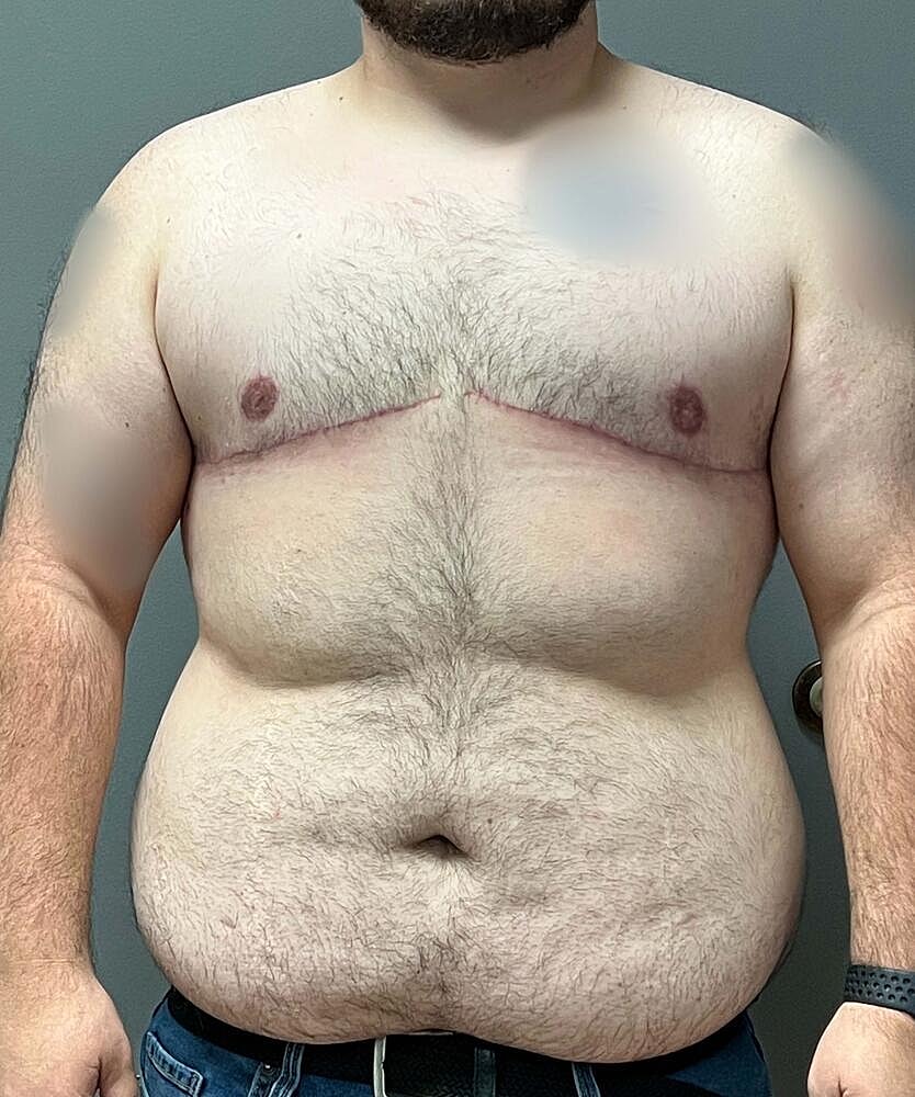 Ftm Top Surgery Before & After