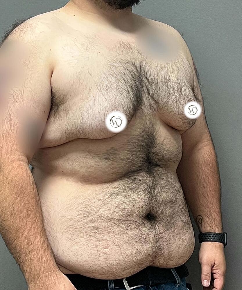 Ftm Top Surgery Before & After