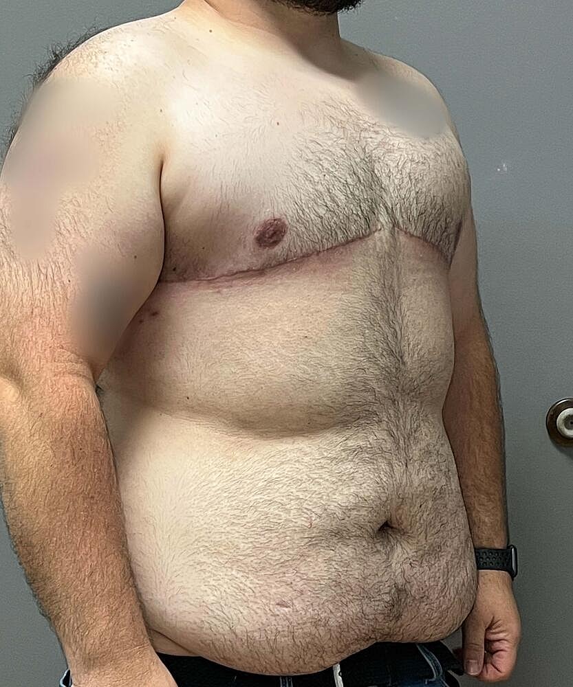 Ftm Top Surgery Before & After