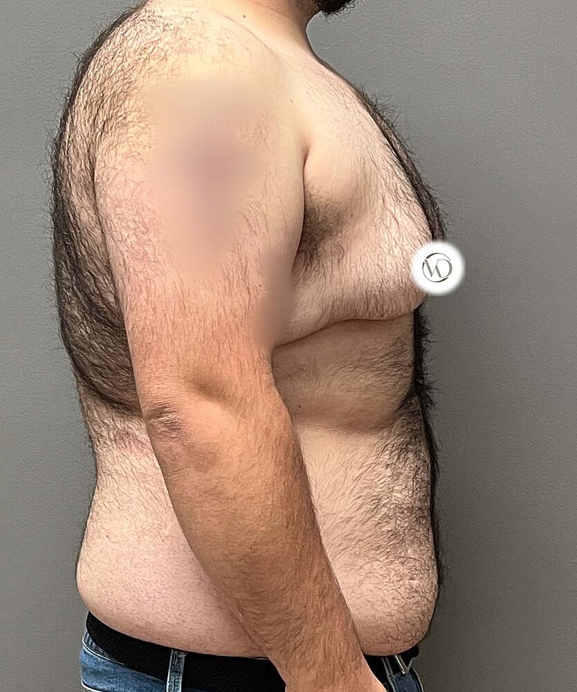 Ftm Top Surgery Before & After