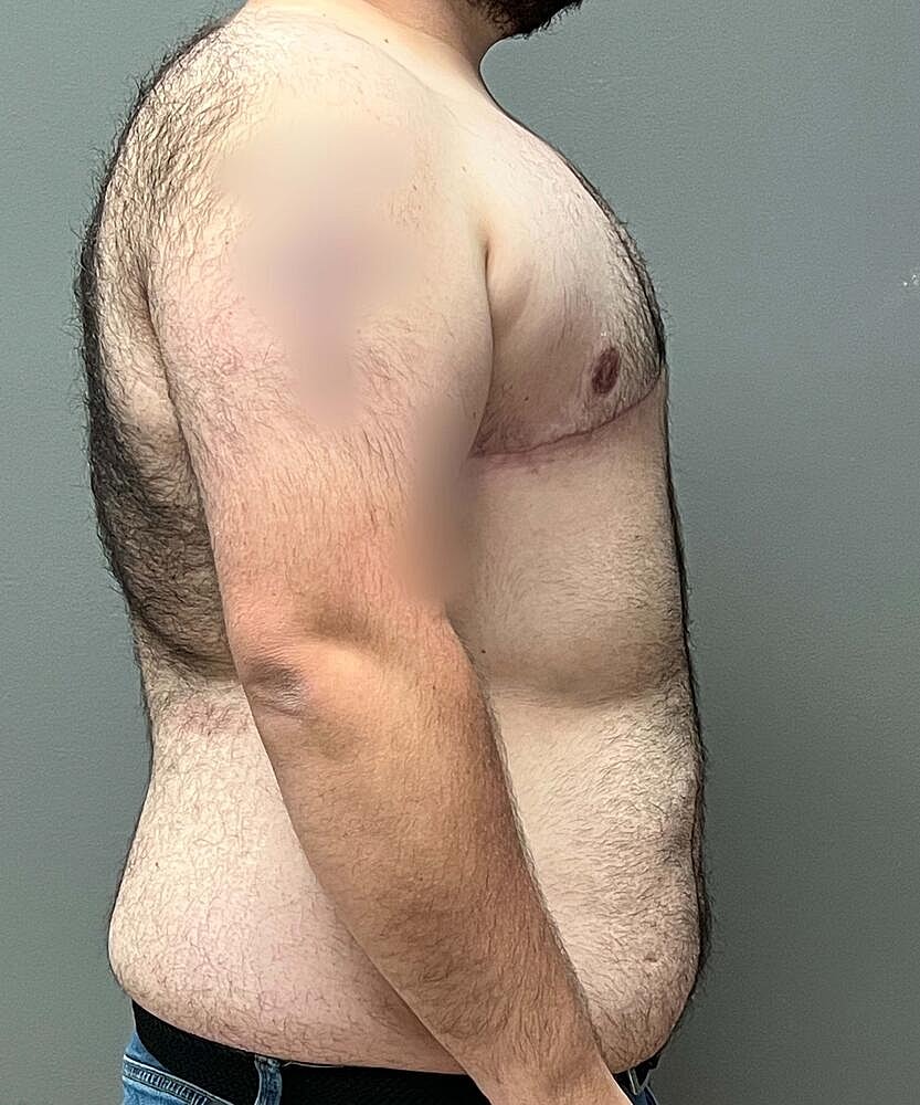 Ftm Top Surgery Before & After