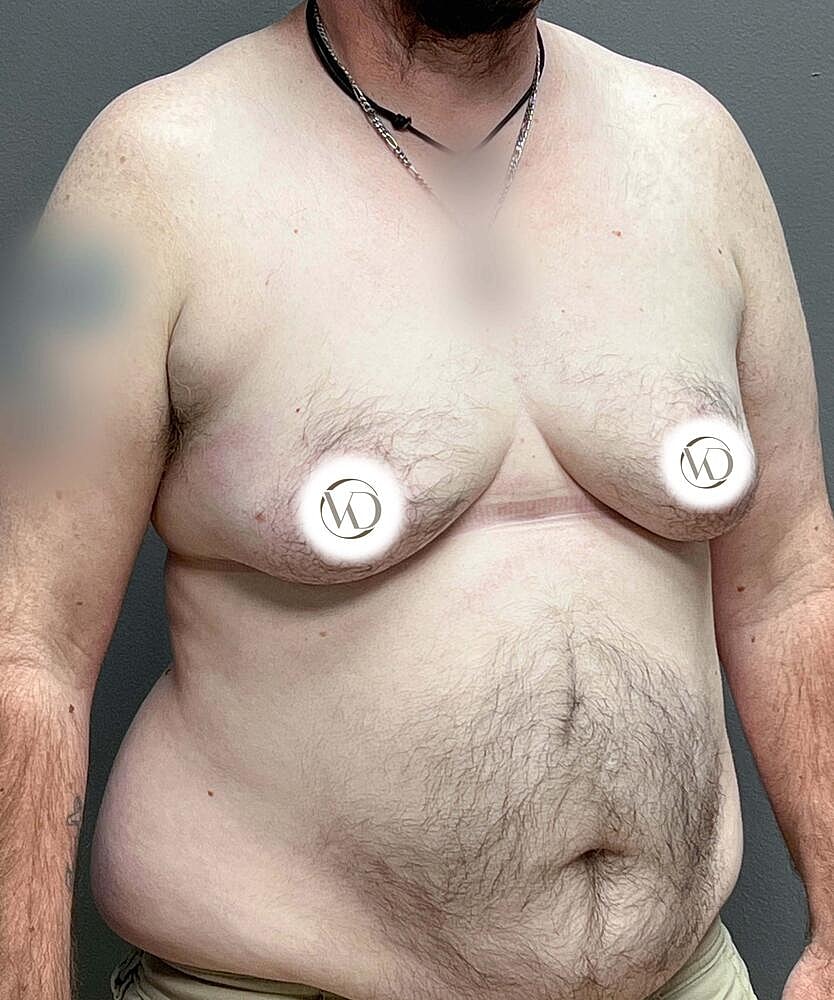Ftm Top Surgery Before & After