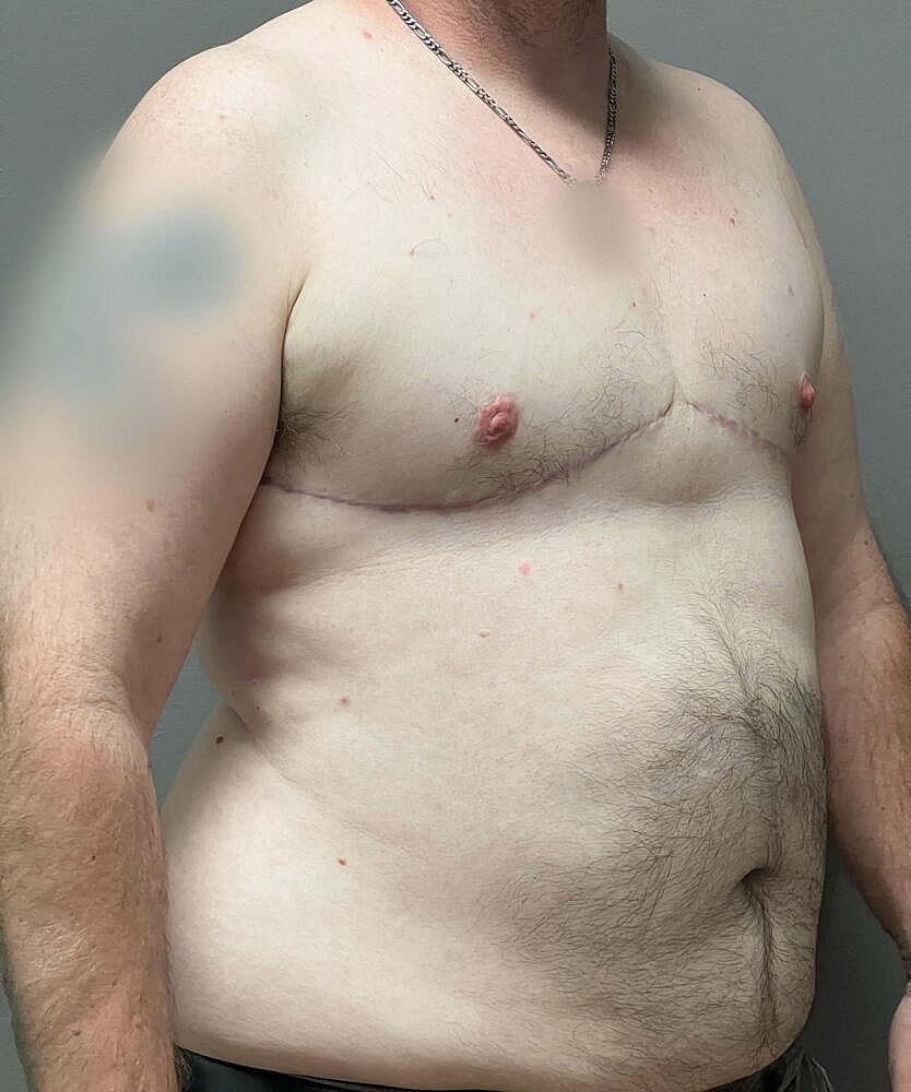 Ftm Top Surgery Before & After