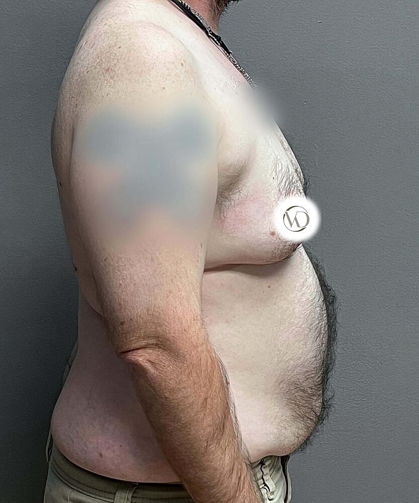 Ftm Top Surgery Before & After