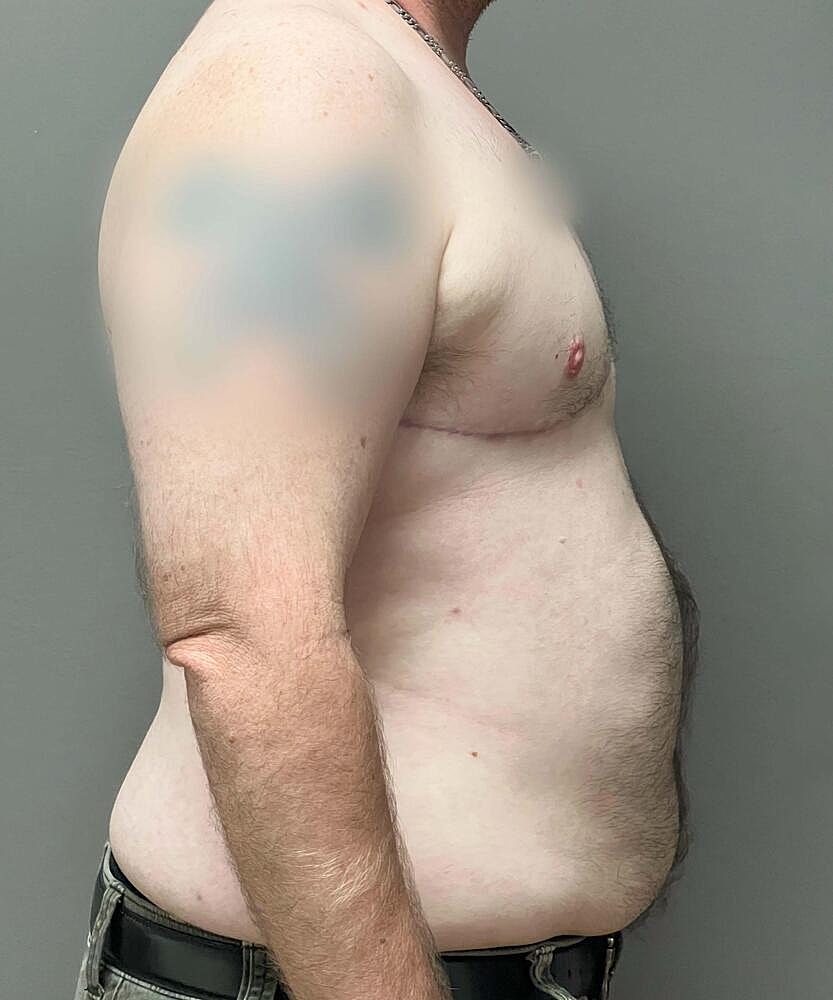 Ftm Top Surgery Before & After