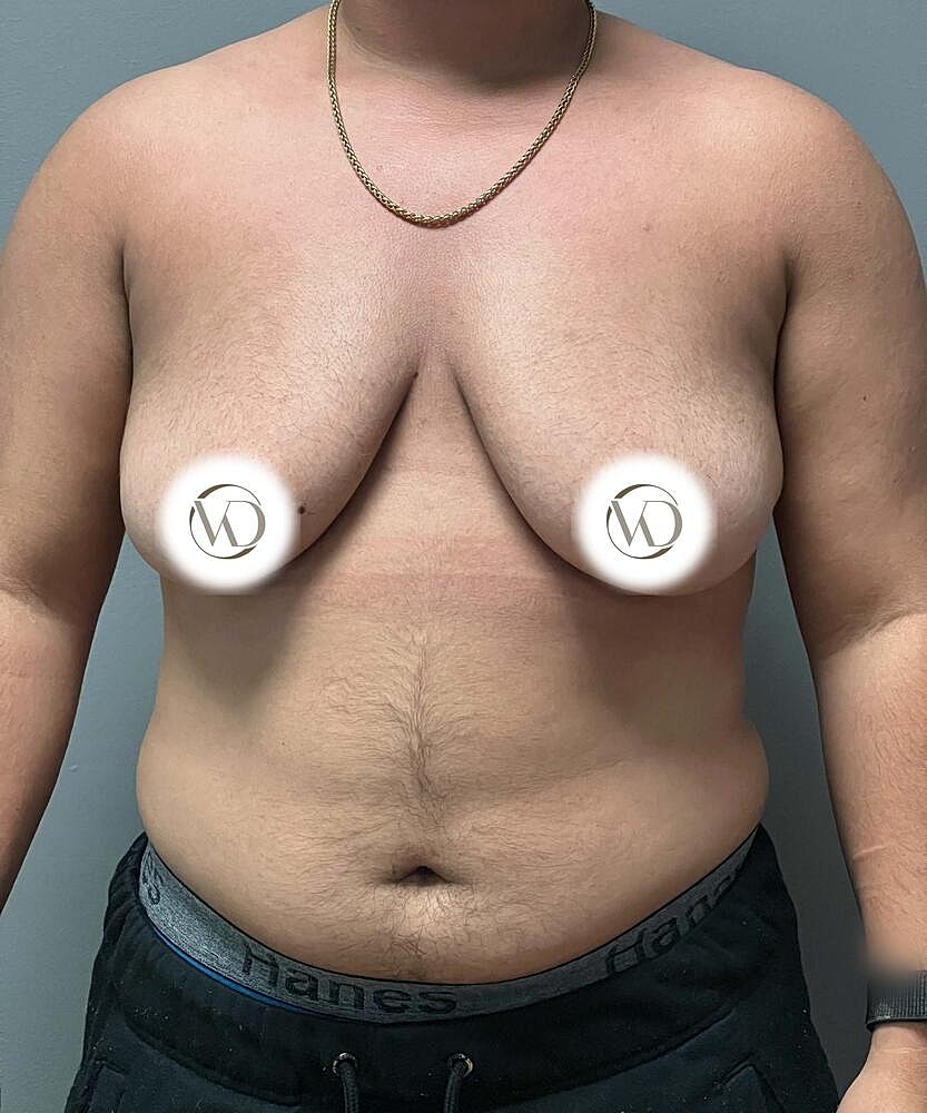 Ftm Top Surgery Before & After
