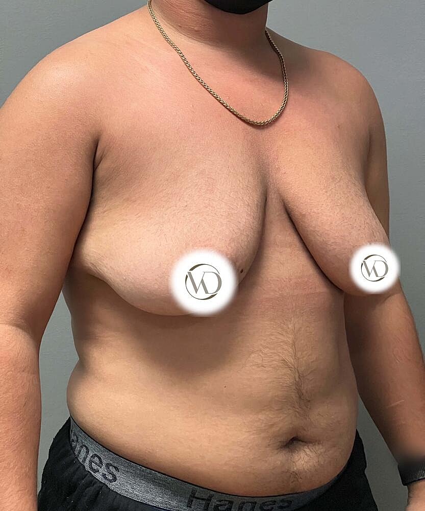 Ftm Top Surgery Before & After