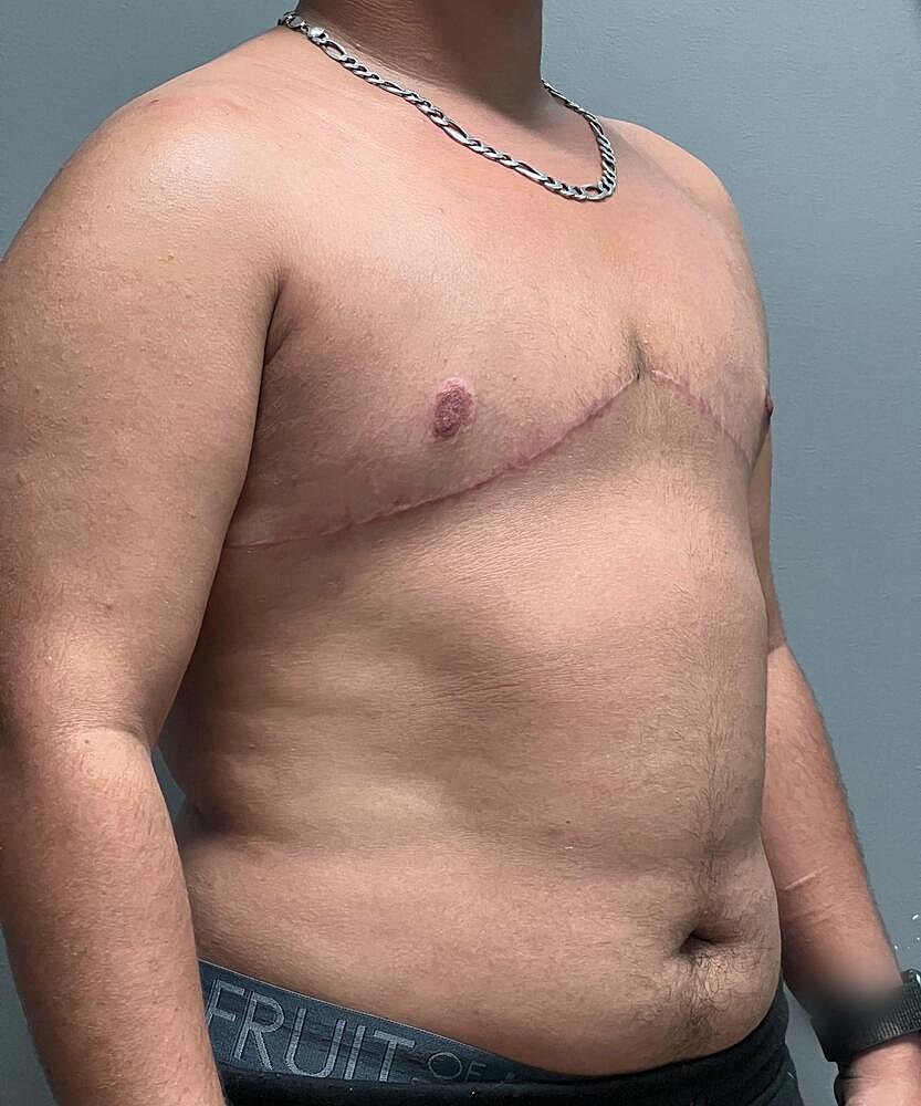 Ftm Top Surgery Before & After
