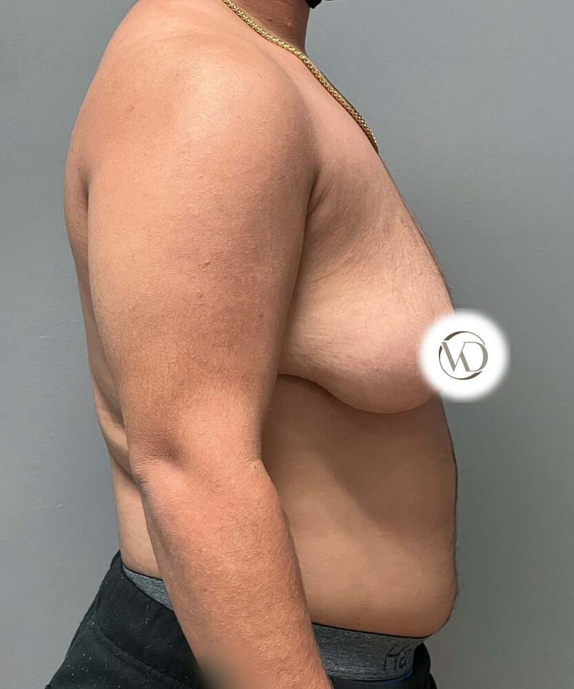 Ftm Top Surgery Before & After