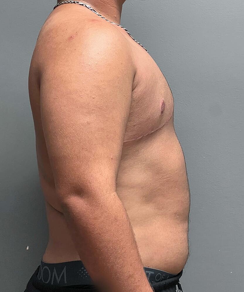 Ftm Top Surgery Before & After