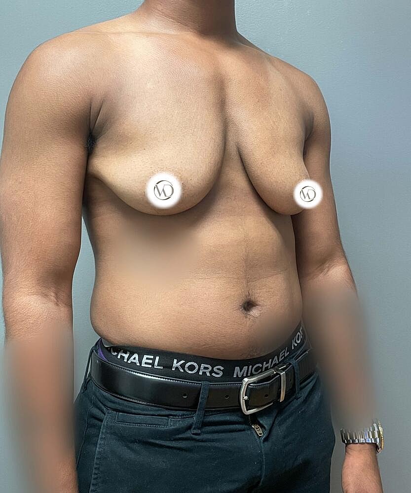 Ftm Top Surgery Before & After
