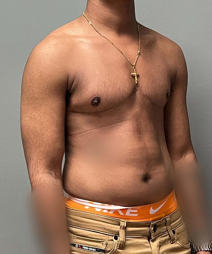 Ftm Top Surgery Before & After