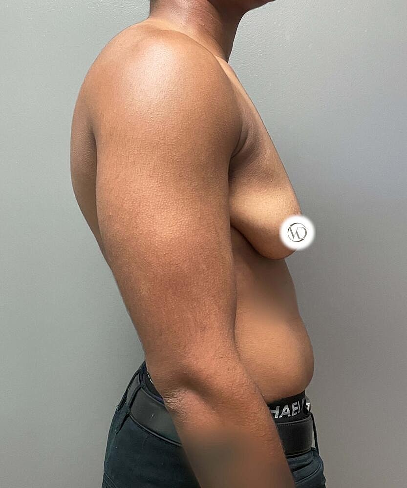 Ftm Top Surgery Before & After