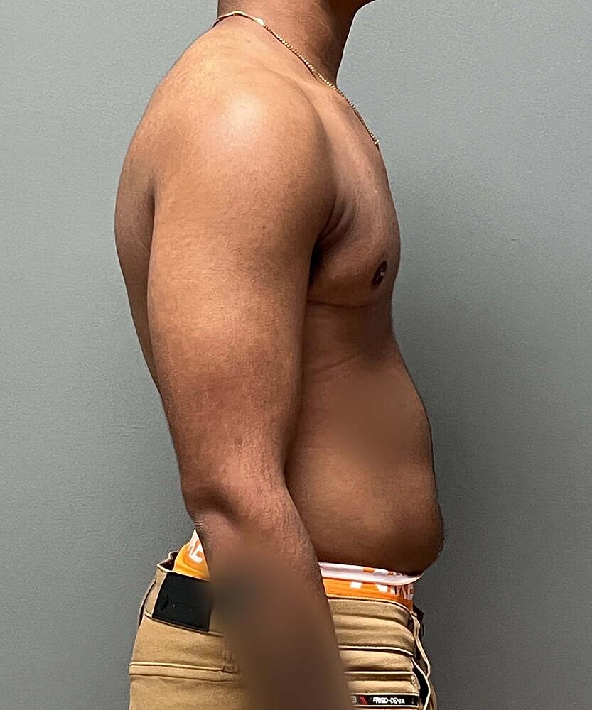 Ftm Top Surgery Before & After