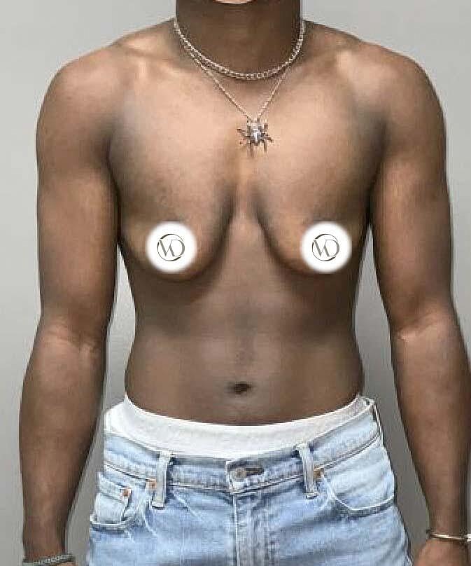 Ftm Top Surgery Before & After