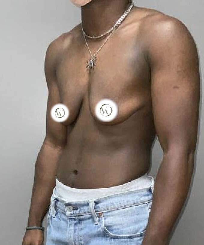 Ftm Top Surgery Before & After