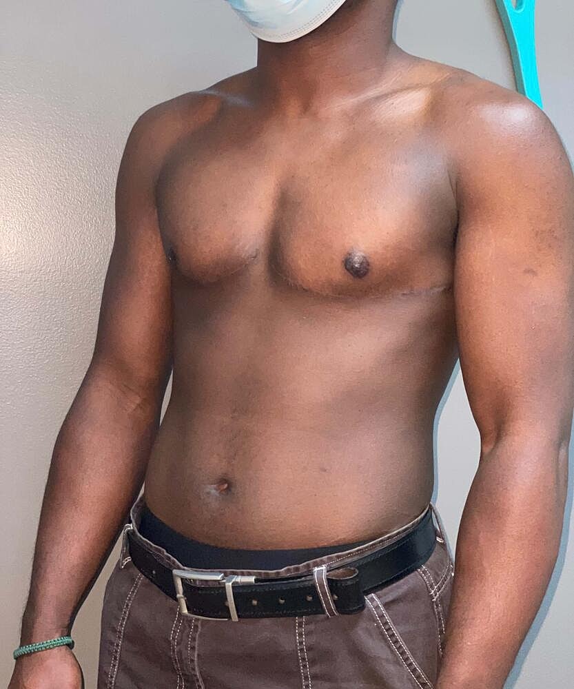 Ftm Top Surgery Before & After