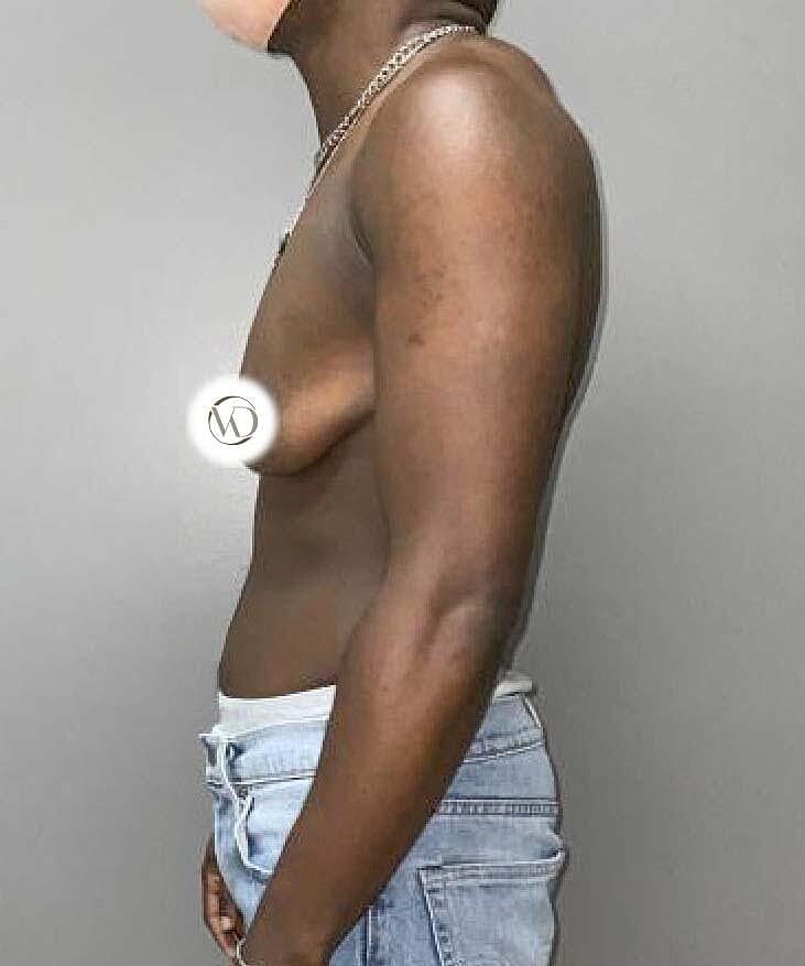 Ftm Top Surgery Before & After