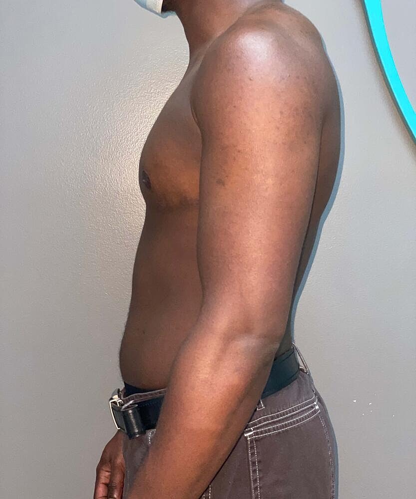Ftm Top Surgery Before & After