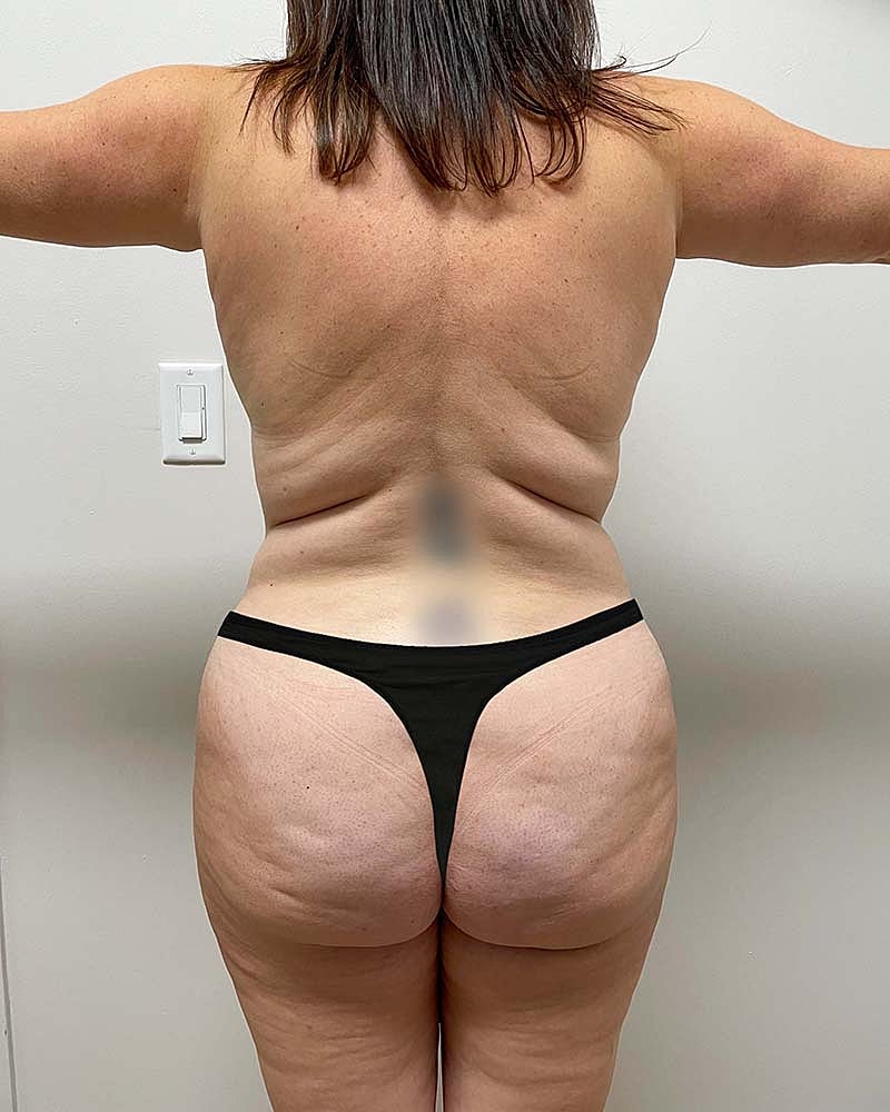 Mommy Makeover Before & After